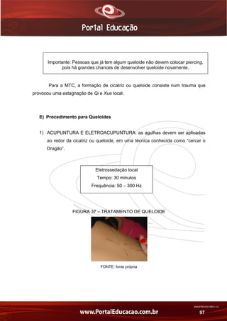 AN02FREV001/REV 4.0
97
Para a MTC, a formação de cicatriz ou queloide consiste num trauma que
provocou uma estagnação de Qi e Xue local.
E) Procedimento para Queloides
1) ACUPUNTURA E ELETROACUPUNTURA: as agulhas devem ser aplicadas
ao redor da cicatriz ou queloide, em uma técnica conhecida como “cercar o
Dragão”.
FIGURA 37 – TRATAMENTO DE QUELOIDE
FONTE: fonte própria
Importante: Pessoas que já tem algum queloide não devem colocar piercing,
pois há grandes chances de desenvolver queloide novamente.
Eletrossedação local
Tempo: 30 minutos
Frequência: 50 – 300 Hz
 