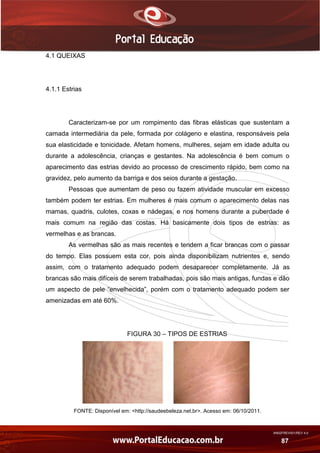 AN02FREV001/REV 4.0
87
4.1 QUEIXAS
4.1.1 Estrias
Caracterizam-se por um rompimento das fibras elásticas que sustentam a
camada intermediária da pele, formada por colágeno e elastina, responsáveis pela
sua elasticidade e tonicidade. Afetam homens, mulheres, sejam em idade adulta ou
durante a adolescência, crianças e gestantes. Na adolescência é bem comum o
aparecimento das estrias devido ao processo de crescimento rápido, bem como na
gravidez, pelo aumento da barriga e dos seios durante a gestação.
Pessoas que aumentam de peso ou fazem atividade muscular em excesso
também podem ter estrias. Em mulheres é mais comum o aparecimento delas nas
mamas, quadris, culotes, coxas e nádegas, e nos homens durante a puberdade é
mais comum na região das costas. Há basicamente dois tipos de estrias: as
vermelhas e as brancas.
As vermelhas são as mais recentes e tendem a ficar brancas com o passar
do tempo. Elas possuem esta cor, pois ainda disponibilizam nutrientes e, sendo
assim, com o tratamento adequado podem desaparecer completamente. Já as
brancas são mais difíceis de serem trabalhadas, pois são mais antigas, fundas e dão
um aspecto de pele “envelhecida”, porém com o tratamento adequado podem ser
amenizadas em até 60%.
FIGURA 30 – TIPOS DE ESTRIAS
FONTE: Disponível em: <http://saudeebeleza.net.br>. Acesso em: 06/10/2011.
 