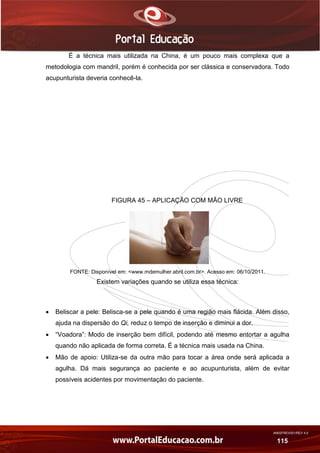 AN02FREV001/REV 4.0
115
É a técnica mais utilizada na China, é um pouco mais complexa que a
metodologia com mandril, porém é conhecida por ser clássica e conservadora. Todo
acupunturista deveria conhecê-la.
FIGURA 45 – APLICAÇÃO COM MÃO LIVRE
FONTE: Disponível em: <www.mdemulher.abril.com.br>. Acesso em: 06/10/2011.
Existem variações quando se utiliza essa técnica:
 Beliscar a pele: Belisca-se a pele quando é uma região mais flácida. Além disso,
ajuda na dispersão do Qi, reduz o tempo de inserção e diminui a dor.
 “Voadora”: Modo de inserção bem difícil, podendo até mesmo entortar a agulha
quando não aplicada de forma correta. É a técnica mais usada na China.
 Mão de apoio: Utiliza-se da outra mão para tocar a área onde será aplicada a
agulha. Dá mais segurança ao paciente e ao acupunturista, além de evitar
possíveis acidentes por movimentação do paciente.
 