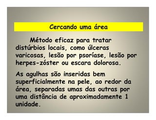 Cercando uma área
Método eficaz para tratar
distúrbios locais, como úlceras
varicosas, lesão por psoríase, lesão por
herpes-zóster ou escara dolorosa.
As agulhas são inseridas bem
superficialmente na pele, ao redor da
área, separadas umas das outras por
uma distância de aproximadamente 1
unidade.
 