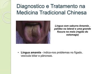 Diagnostico e Tratamento na
Medicina Tradicional Chinesa
Língua com saburra Amarela ,
palidez na lateral e uma grande
fissura no meio (região do
estomago)
• Língua amarela - indica-nos problemas no fígado,
vesícula biliar e pâncreas.
 