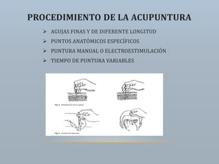 PROCEDIMIENTO DE LA ACUPUNTURA
 AGUJAS FINAS Y DE DIFERENTE LONGITUD
 PUNTOS ANATÓMICOS ESPECÍFICOS
 PUNTURA MANUAL O ELECTROESTIMULACIÓN
 TIEMPO DE PUNTURA VARIABLES
 