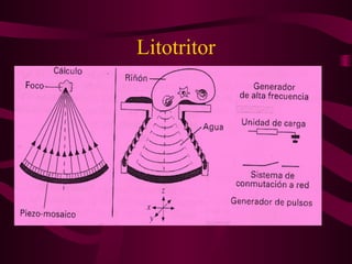 Litotritor
 