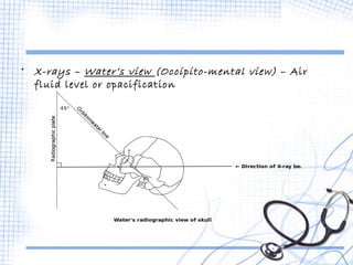 • X-rays – Water’s view (Occipito-mental view) – Air 
fluid level or opacification 
 