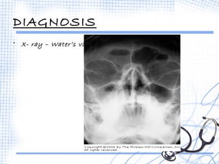 DIAGNOSIS 
• X- ray – Water’s view 
 