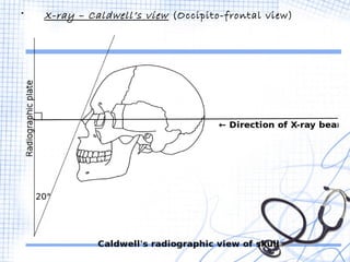 • X-ray – Caldwell’s view (Occipito-frontal view) 
 