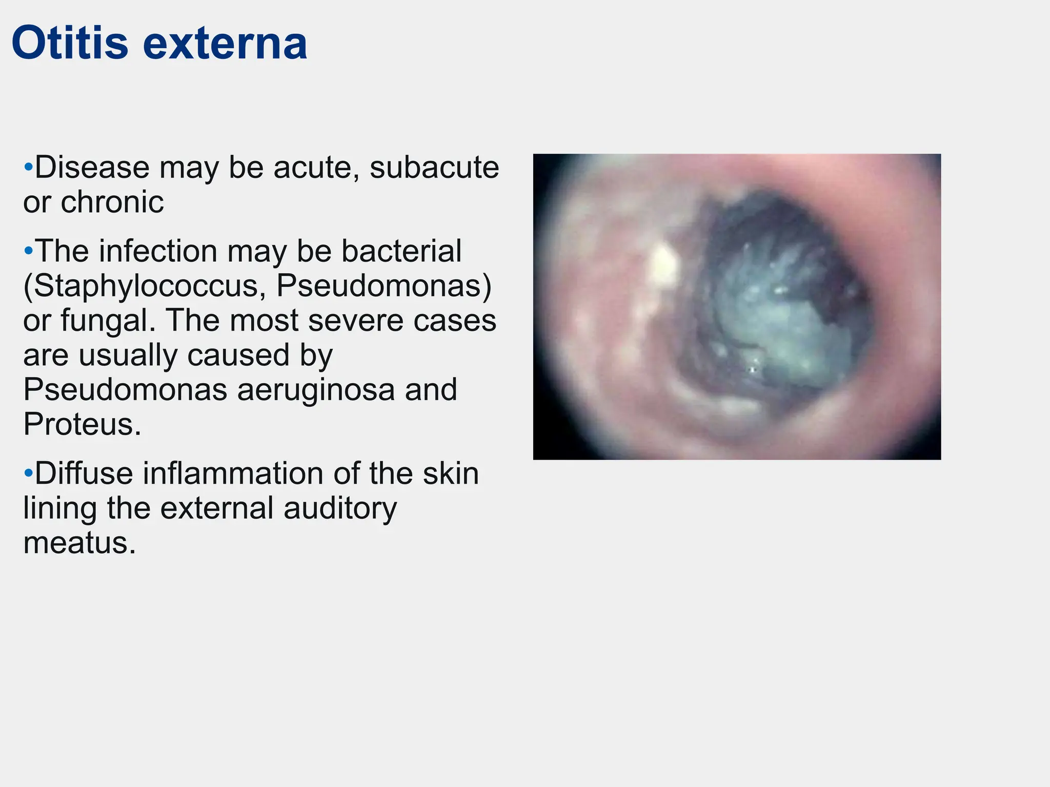 Otitis externa
•Disease may be acute, subacute
or chronic
•The infection may be bacterial
(Staphylococcus, Pseudomonas)
or fungal. The most severe cases
are usually caused by
Pseudomonas aeruginosa and
Proteus.
•Diffuse inflammation of the skin
lining the external auditory
meatus.
 