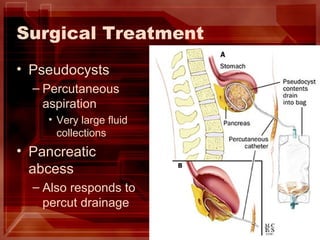 Surgical Treatment Pseudocysts Percutaneous aspiration Very large fluid collections Pancreatic abcess Also responds to percut drainage 