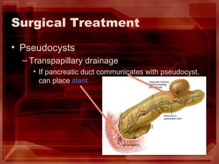 Surgical Treatment Pseudocysts Transpapillary drainage If pancreatic duct communicates with pseudocyst, can place  stent 