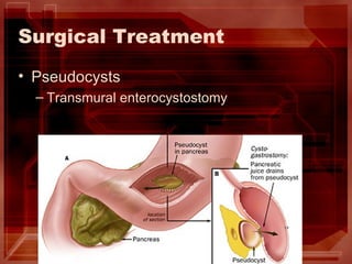 Surgical Treatment Pseudocysts Transmural enterocystostomy  