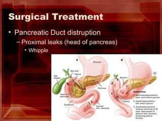 Surgical Treatment Pancreatic Duct distruption Proximal leaks (head of pancreas) Whipple  
