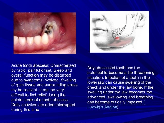 apical periodontitis abscess pulp