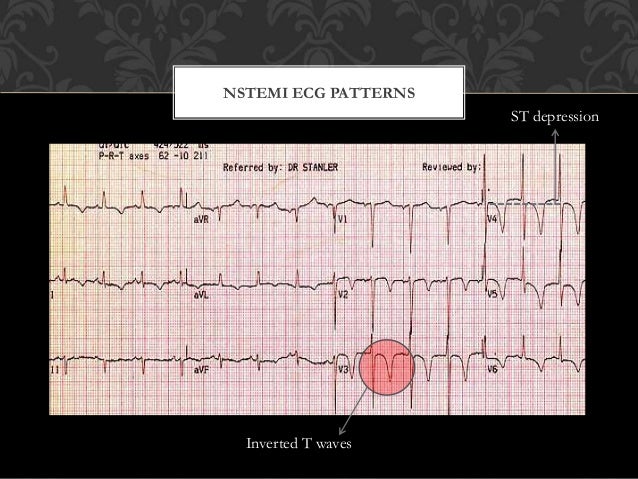 heart t trop test Coronary Acute ECG Syndrome the and