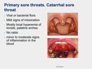 Primary sore throats. Catarrhal sore
throat
• Viral or bacterial flora
• Mild signs of intoxication
• Mostly local hyperemia of
tonsils, palatine arches
• No raids
• minor to moderate signs
of inflammation in the
blood
Архив кафедры
 