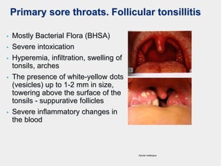 Primary sore throats. Follicular tonsillitis
• Mostly Bacterial Flora (BHSA)
• Severe intoxication
• Hyperemia, infiltration, swelling of
tonsils, arches
• The presence of white-yellow dots
(vesicles) up to 1-2 mm in size,
towering above the surface of the
tonsils - suppurative follicles
• Severe inflammatory changes in
the blood
Архив кафедры
 