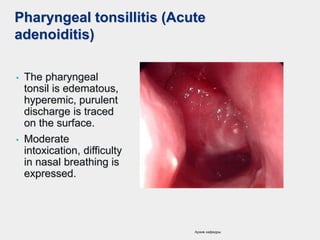 Pharyngeal tonsillitis (Acute
adenoiditis)
• The pharyngeal
tonsil is edematous,
hyperemic, purulent
discharge is traced
on the surface.
• Moderate
intoxication, difficulty
in nasal breathing is
expressed.
Архив кафедры
 