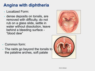 Angina with diphtheria
• Localized Form:
• dense deposits on tonsils, are
removed with difficulty, do not
rub on a glass slide, settle in
water without dissolution, leave
behind a bleeding surface -
“blood dew”
• Common form:
• The raids go beyond the tonsils to
the palatine arches, soft palate
Архив кафедры
 