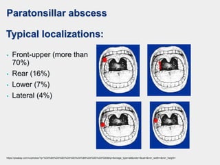 Paratonsillar abscess
Typical localizations:
• Front-upper (more than
70%)
• Rear (16%)
• Lower (7%)
• Lateral (4%)
https://pixabay.com/ru/photos/?q=%D0%B0%D0%BD%D0%B3%D0%B8%D0%BD%D0%B0&hp=&image_type=all&order=&cat=&min_width=&min_height=
 