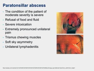 Paratonsillar abscess
• The condition of the patient of
moderate severity is severe
• Refusal of food and fluid
• Severe intoxication
• Extremely pronounced unilateral
pain
• Trismus chewing muscles
• Soft sky asymmetry
• Unilateral lymphadenitis
https://pixabay.com/ru/photos/?q=%D0%B0%D0%BD%D0%B3%D0%B8%D0%BD%D0%B0&hp=&image_type=all&order=&cat=&min_width=&min_height=
 