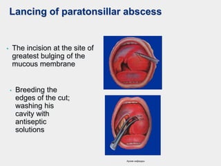 Lancing of paratonsillar abscess
• The incision at the site of
greatest bulging of the
mucous membrane
• Breeding the
edges of the cut;
washing his
cavity with
antiseptic
solutions
Архив кафедры
 