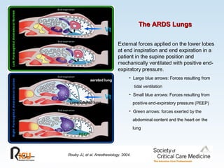 External forces applied on the lower lobes at end inspiration and end expiration in a patient in the supine position and mechanically ventilated with positive end-expiratory pressure.   Large blue arrows: Forces resulting from tidal ventilation   Small blue arrows: Forces resulting from positive end-expiratory pressure (PEEP) Green arrows: forces exerted by the  abdominal content and the heart on the  lung Rouby JJ, et al. Anesthesiology. 2004. aerated lung consolidated lung Vt Vt PEEP The ARDS Lungs 