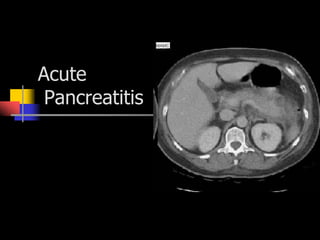 Acute
Pancreatitis
 