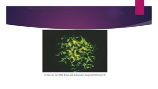 immunofluorescence microscopy
IgG, IgM, and C3 in in the mesangium and along the GBM
 