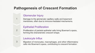 Pathogenesis of Crescent Formation
Glomerular Injury
Damage to the glomerular capillary walls and basement
membrane, often due to immune-mediated mechanisms.
Epithelial Proliferation
Proliferation of parietal epithelial cells lining Bowman's space,
forming the characteristic crescent shape.
Leukocyte Influx
Migration of monocytes, macrophages, and other inflammatory
cells into Bowman's space, contributing to crescent formation.
 