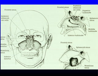 Acute sinusitis-diagnosis-management-and-complications.pre | PPT