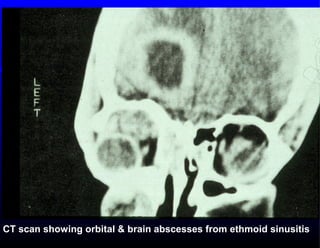 Acute sinusitis-diagnosis-management-and-complications.pre | PPT