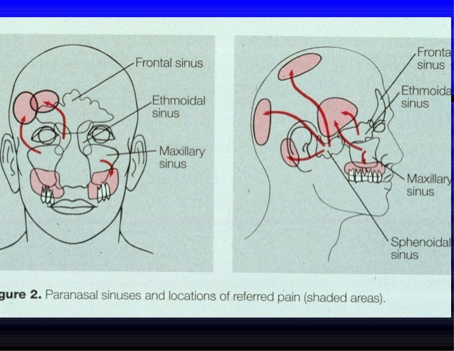 Acute sinusitis-diagnosis-management 