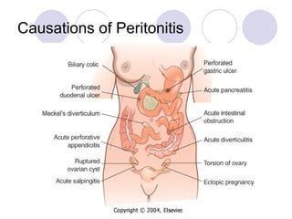 Causations of Peritonitis 