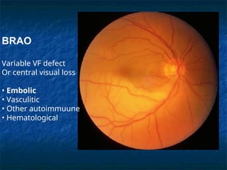 Acute-Visual-Loss-Emergency-Room-Perspective.ppt