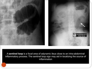 A sentinel loop is a focal area of adynamic ileus close to an intra-abdominal
inflammatory process. The sentinel loop sign may aid in localizing the source of
inflammation
 