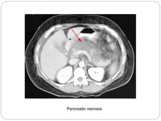 Pancreatic necrosis
 