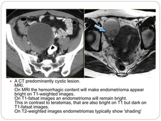  A CT predominantly cystic lesion.
MRI.
On MRI the hemorrhagic content will make endometrioma appear
bright on T1-weighted images.
On T1-fatsat images an endometrioma will remain bright.
This in contrast to teratomas, that are also bright on T1 but dark on
T1-fatsat images.
On T2-weighted images endometriomas typically show 'shading'
 