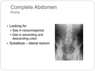 Complete Abdomen
Prone
 Looking for
 Gas in rectum/sigmoid
 Gas in ascending and
descending colon
 Substitute – lateral rectum
 