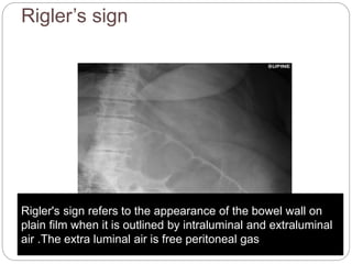 Acute abdomen | PPTX