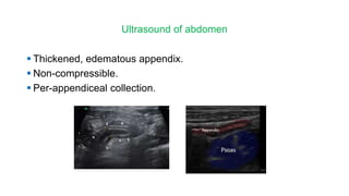 Acute abdomen in children | PPTX