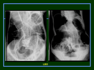 Acute abdomen | PPT