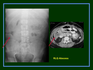 Acute abdomen | PPT