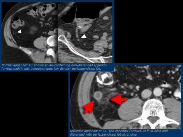 Acute Abdomen-Radiology | PPTX