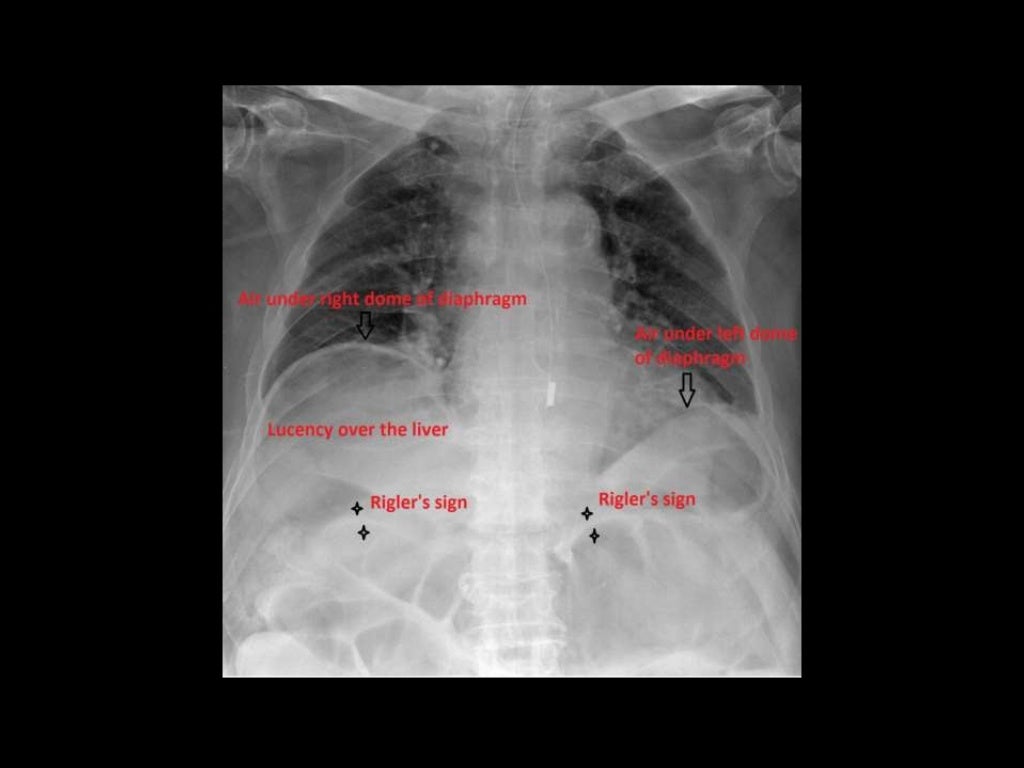 Acute AbdomenRadiology