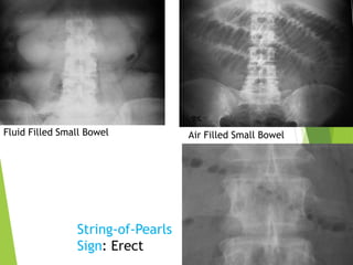 Fluid Filled Small Bowel Air Filled Small Bowel
String-of-Pearls
Sign: Erect
 