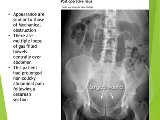 • Appearance are
similar to those
of Mechanical
obstruction
• There are
multiple loops
of gas filled
bowels
centrally over
abdomen
• This patient
had prolonged
non colicky
abdominal pain
following a
cesarean
section
 