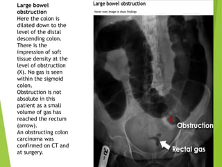 Large bowel
obstruction
Here the colon is
dilated down to the
level of the distal
descending colon.
There is the
impression of soft
tissue density at the
level of obstruction
(X). No gas is seen
within the sigmoid
colon.
Obstruction is not
absolute in this
patient as a small
volume of gas has
reached the rectum
(arrow).
An obstructing colon
carcinoma was
confirmed on CT and
at surgery.
 