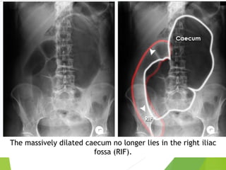 The massively dilated caecum no longer lies in the right iliac
fossa (RIF).
 