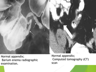 Normal appendix;
Barium enema radiographic
examination.
Normal appendix;
Computed tomography (CT)
scan
 