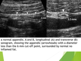 a normal appendix. A and B, longitudinal (A) and transverse (B)
sonogram, showing the appendix (arrowheads) with a diameter
less than the 6 mm cut-off point, surrounded by normal no
inflamed fat.
 