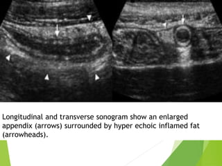 Longitudinal and transverse sonogram show an enlarged
appendix (arrows) surrounded by hyper echoic inflamed fat
(arrowheads).
 